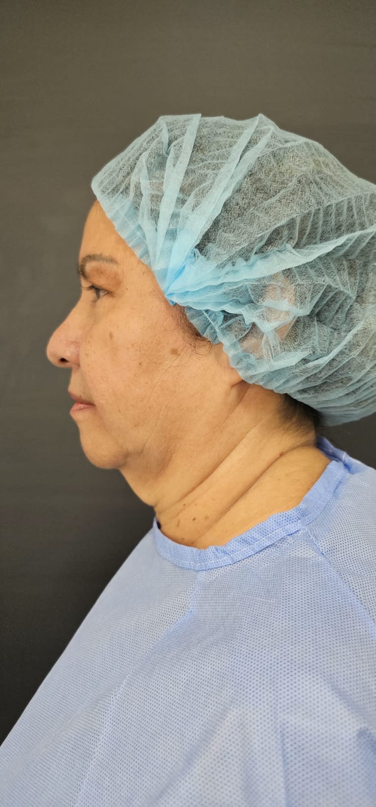Antes Lifting Facial Deep Plane Case 3